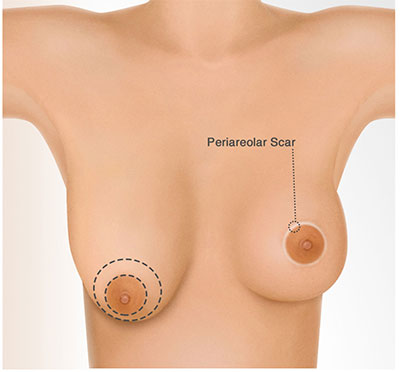 best breast lift surgery abroad